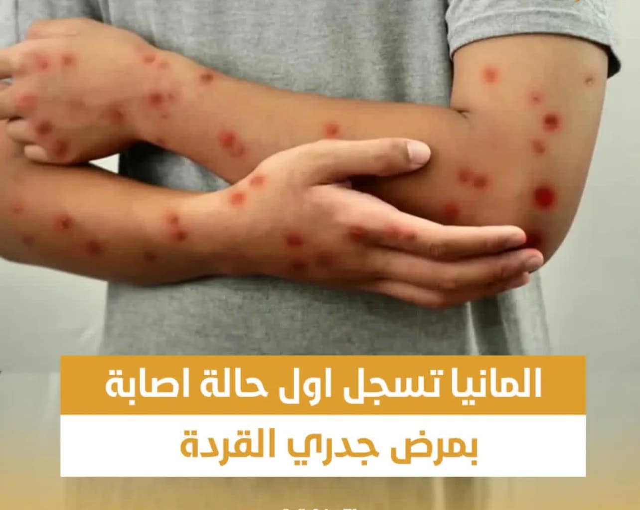 ألمانيا تسجل أول حالة إصابة بمرض جدري القردة